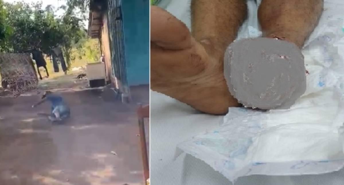 Homem sofre grave ferimento no pé após pisar em bombinha durante brincadeira em Rondônia